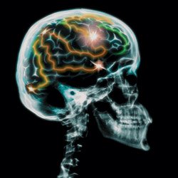 Brain Injury