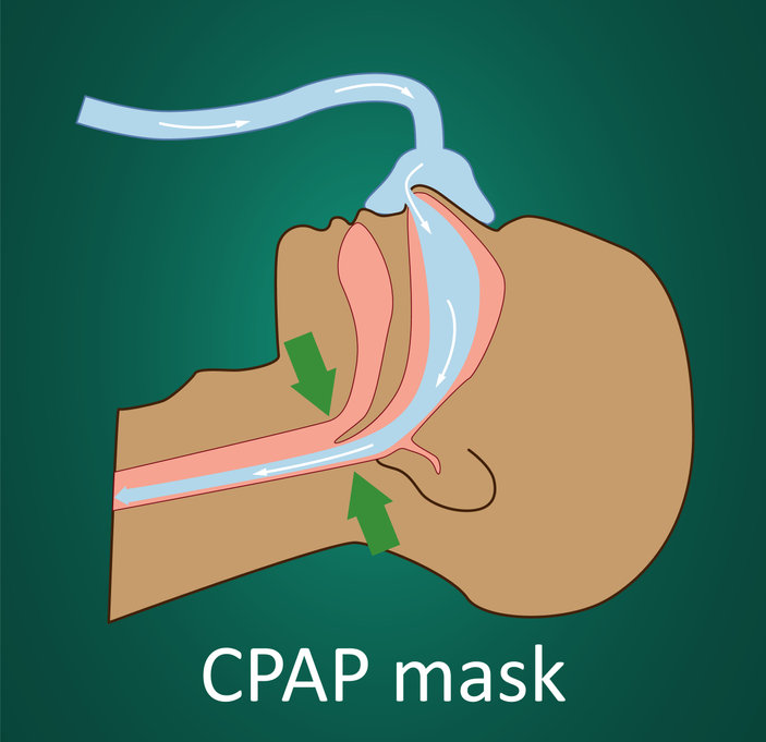 Philips CPAP Lawsuits Sleep Apnea Device Recalls MDL 3014