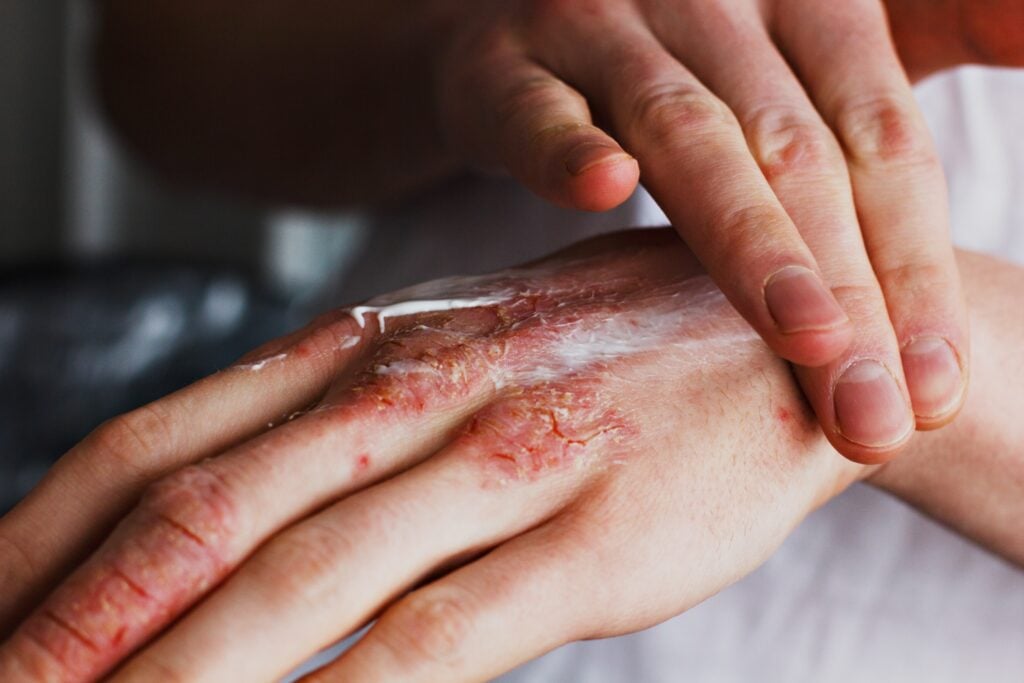 Summerlin Burn Injury Lawyers