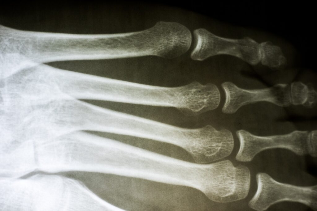 Colorado Bone Fractures Lawyer