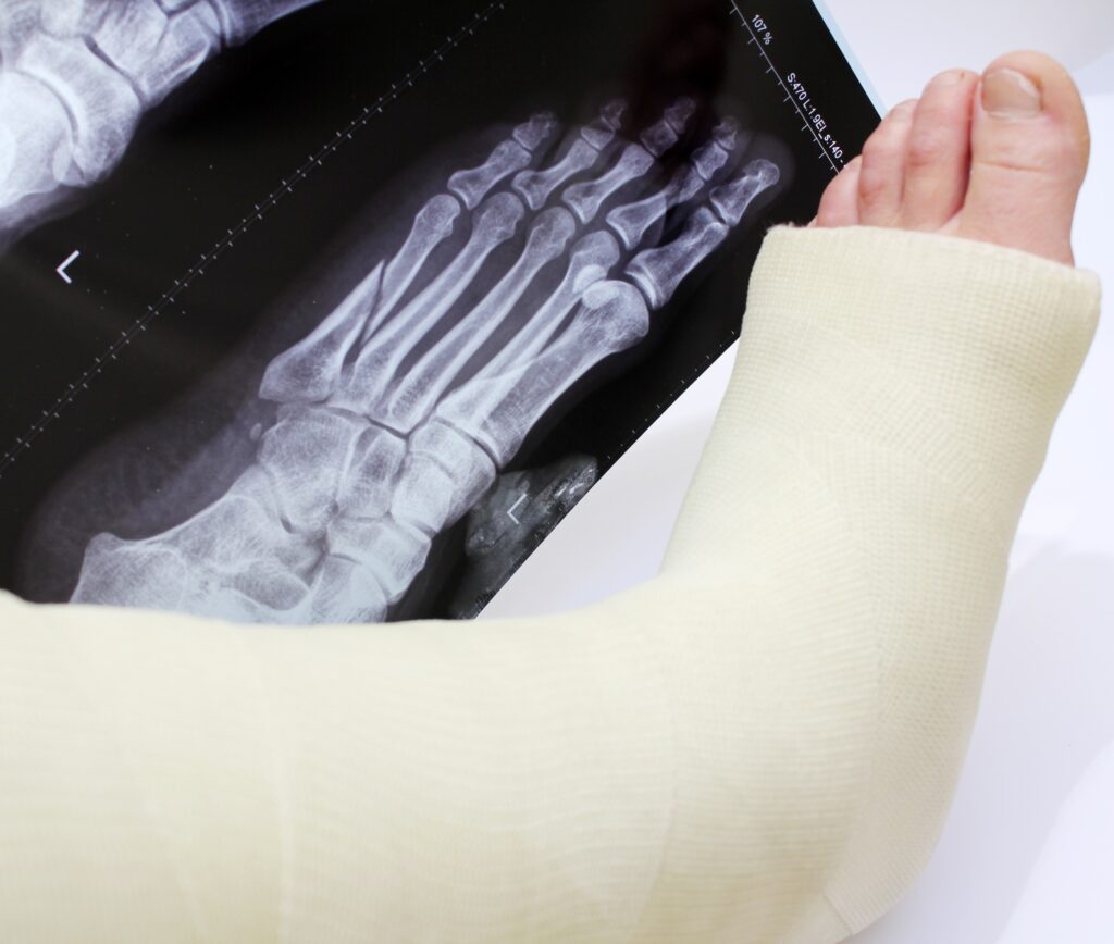 Mesa Bone Fractures Lawyer