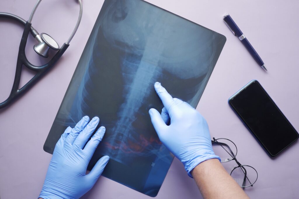 Valparaiso Bone Fracture Lawyer