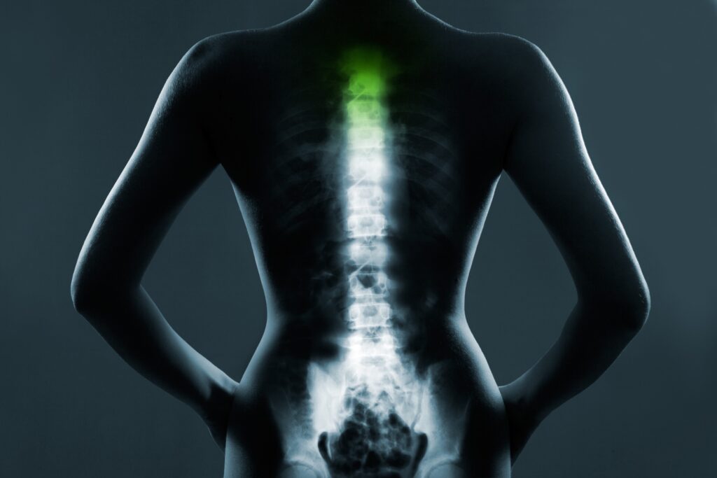 Glendale Spinal Injury Lawyers