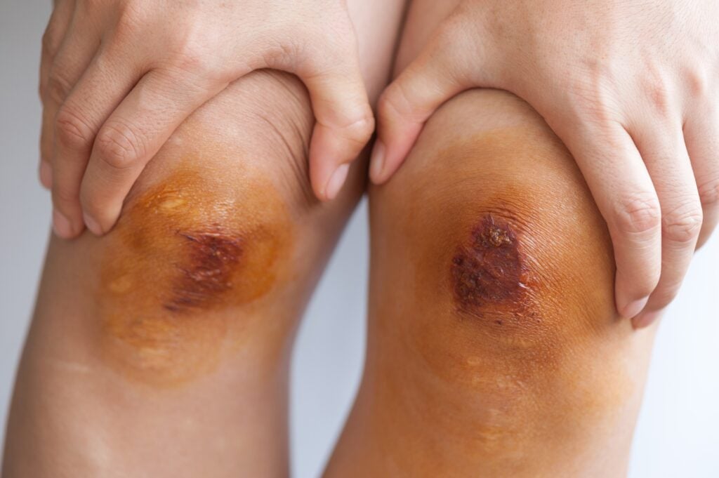 Abogados de lesiones por quemaduras en Henderson, Nevada