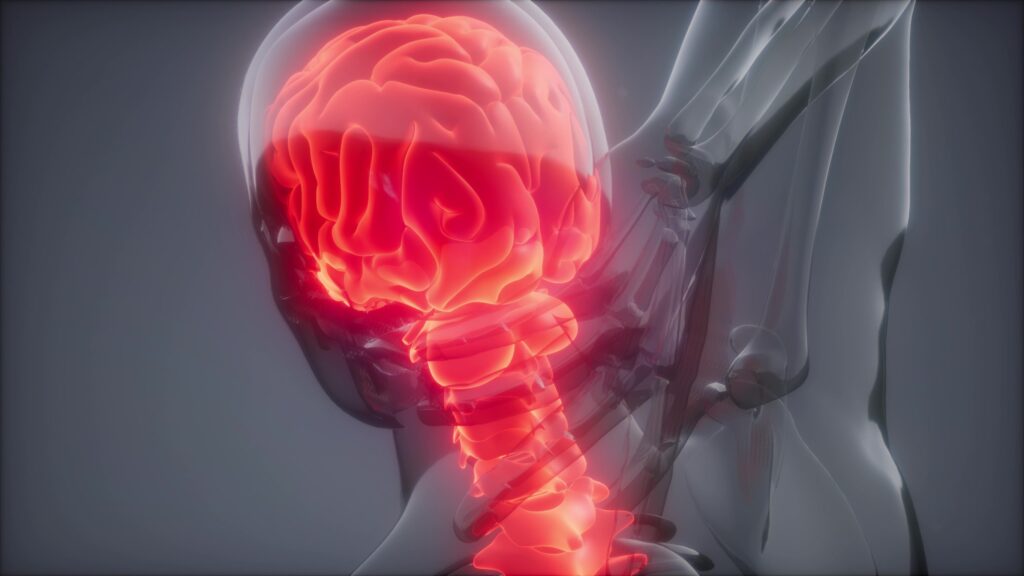 Arrowhead Whiplash Injury Lawyer