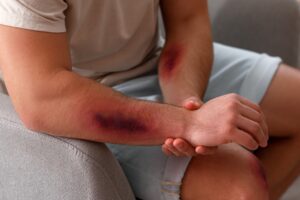 Farmington Burn Injuries Lawyer