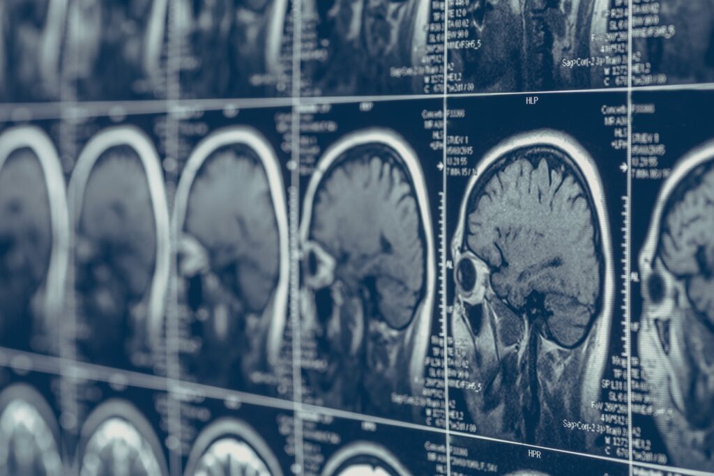 Abogados en lesiones cerebrales en Yuma