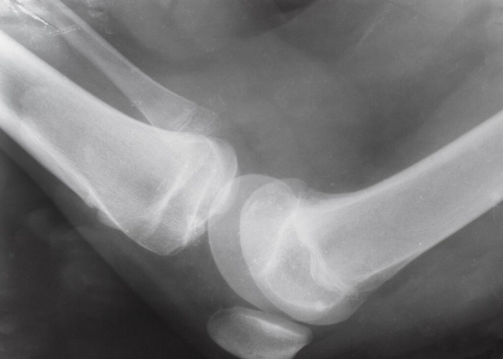 Dayton Bone Fractures Lawyer