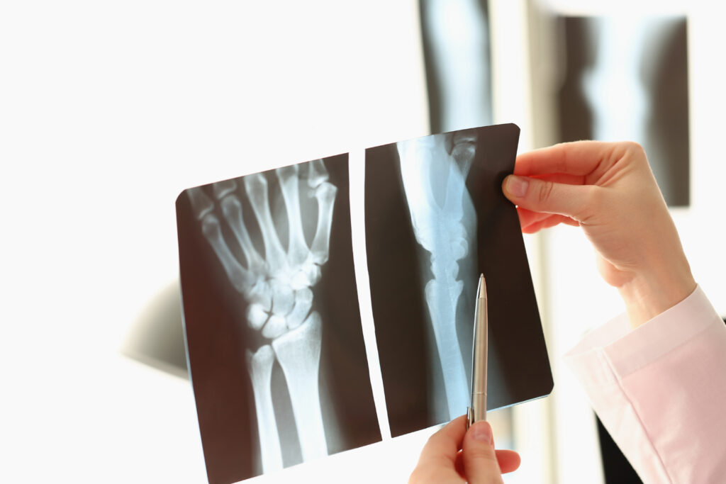 Silver Springs Bone Fractures Lawyer