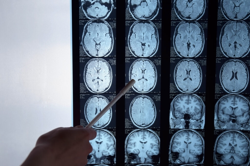 Silver Springs Brain Injury Lawyer