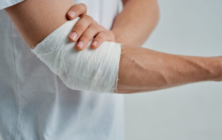 Silver Springs Burn Injuries Lawyer