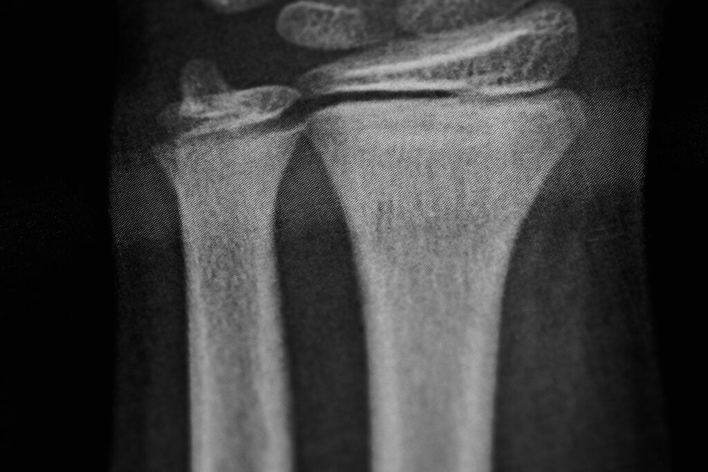 Sun Valley Bone Fractures Lawyer