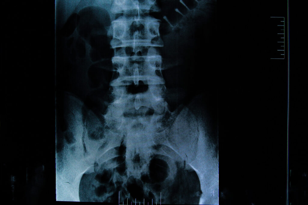Hawthorne Spinal Injury Lawyer
