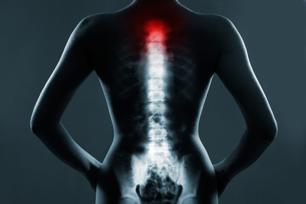 Roswell Spinal Injury Lawyer