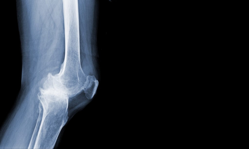 Hawthorne Bone Fractures Lawyer
