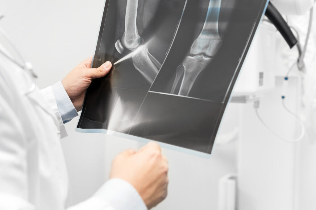 Kingsbury Bone Fractures Lawyer