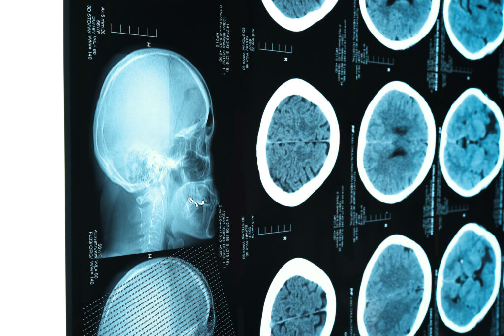 Kingsbury Brain Injury Lawyer