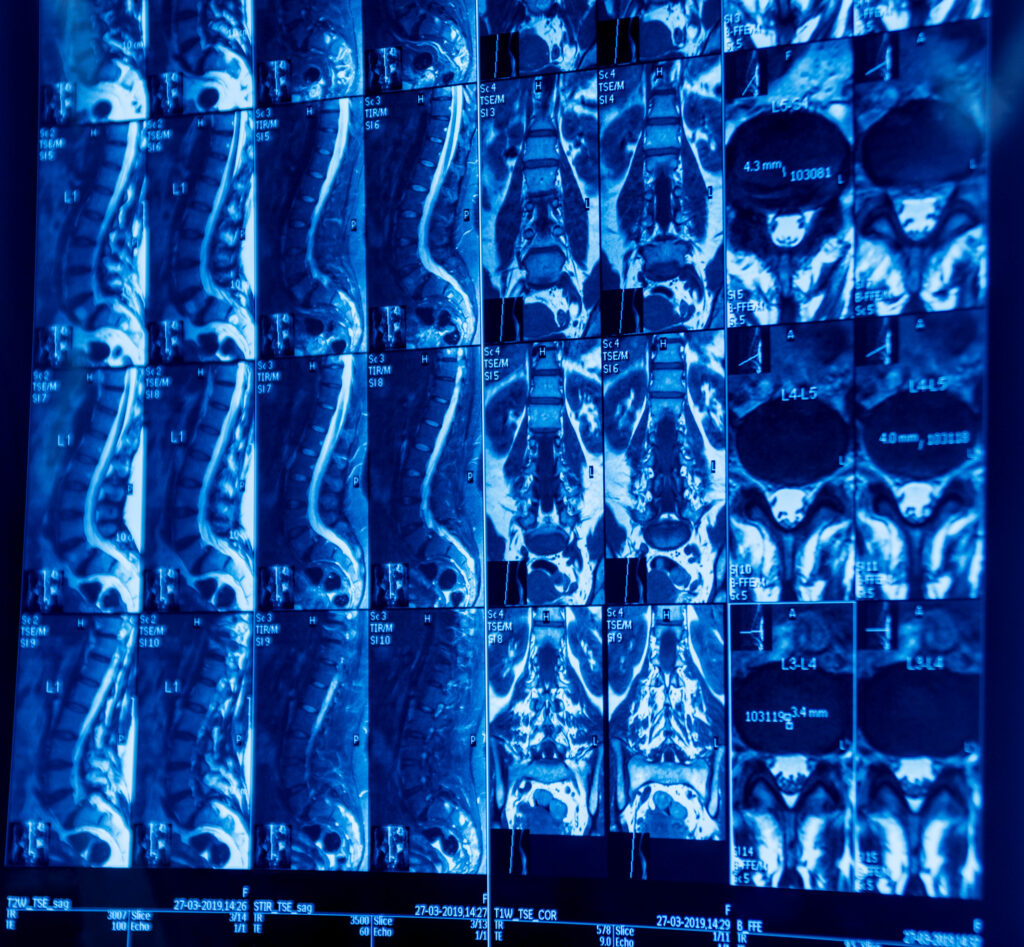 Kingsbury Spinal Injury Lawyer