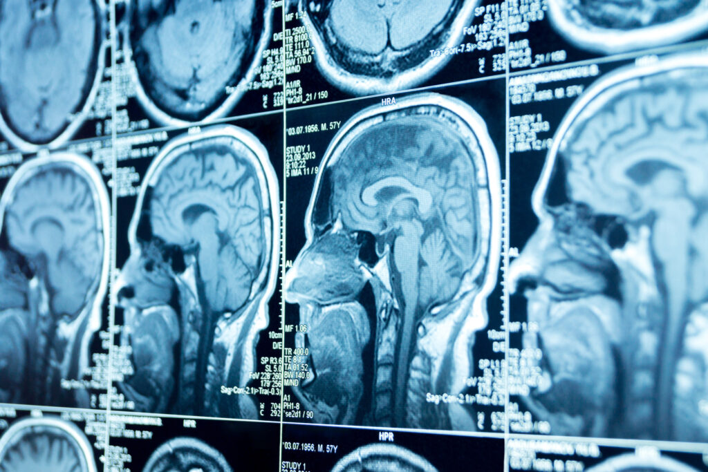 Carlin Brain Injury Lawyer