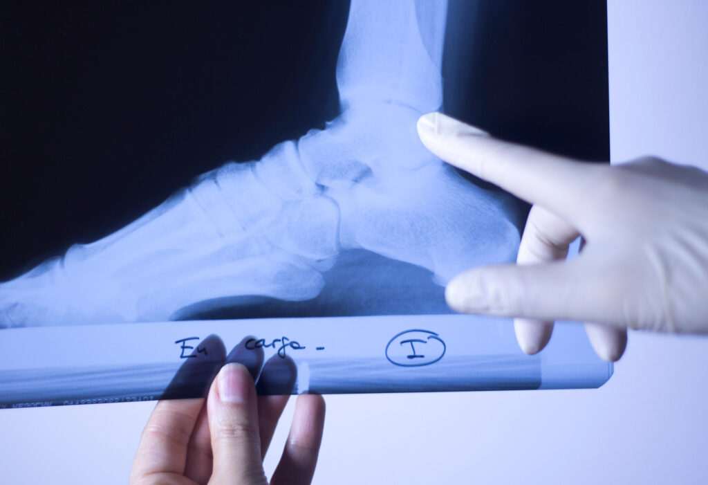 Naperville Bone Fractures Lawyer