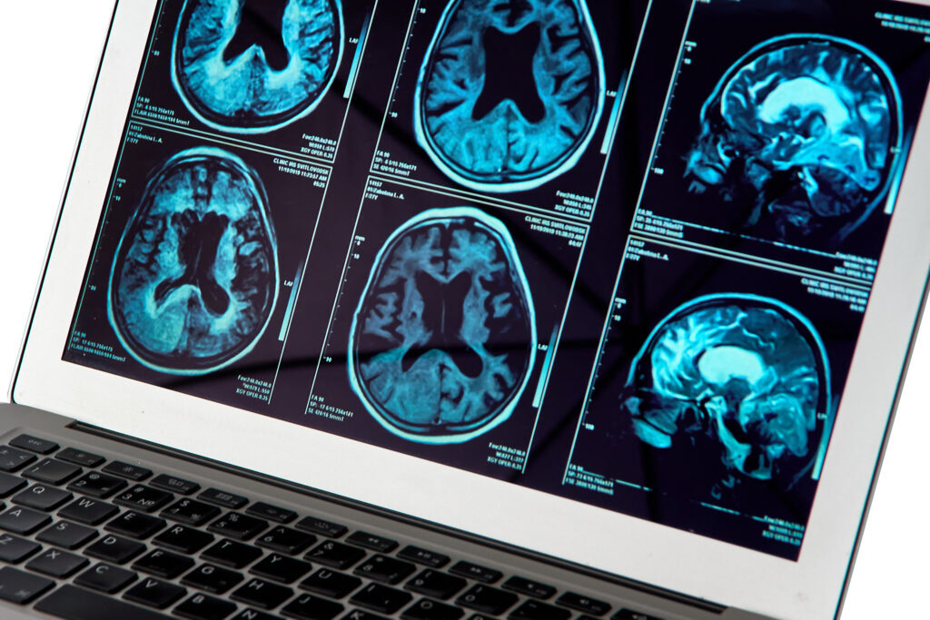 Naperville Brain Injury Lawyer