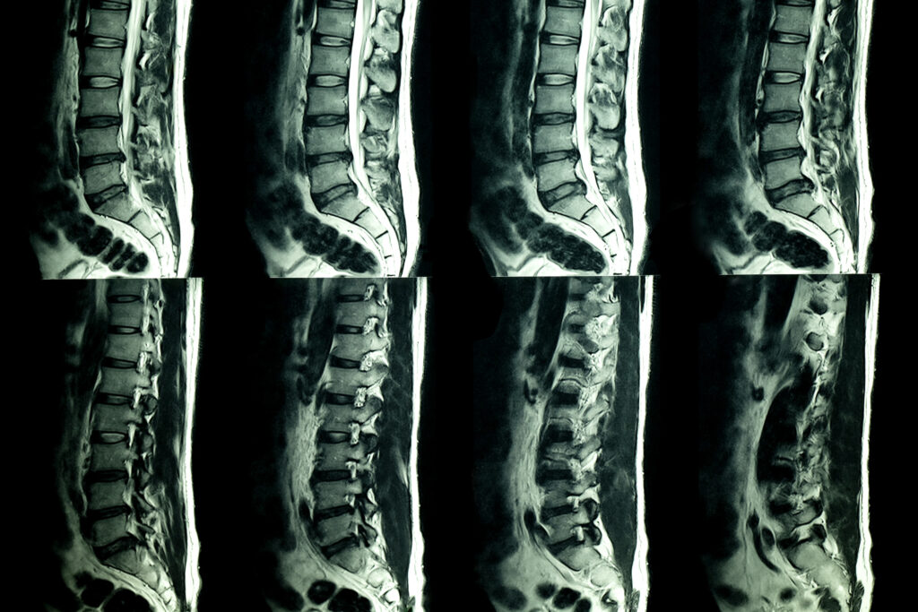 Naperville Spinal Injury Lawyer