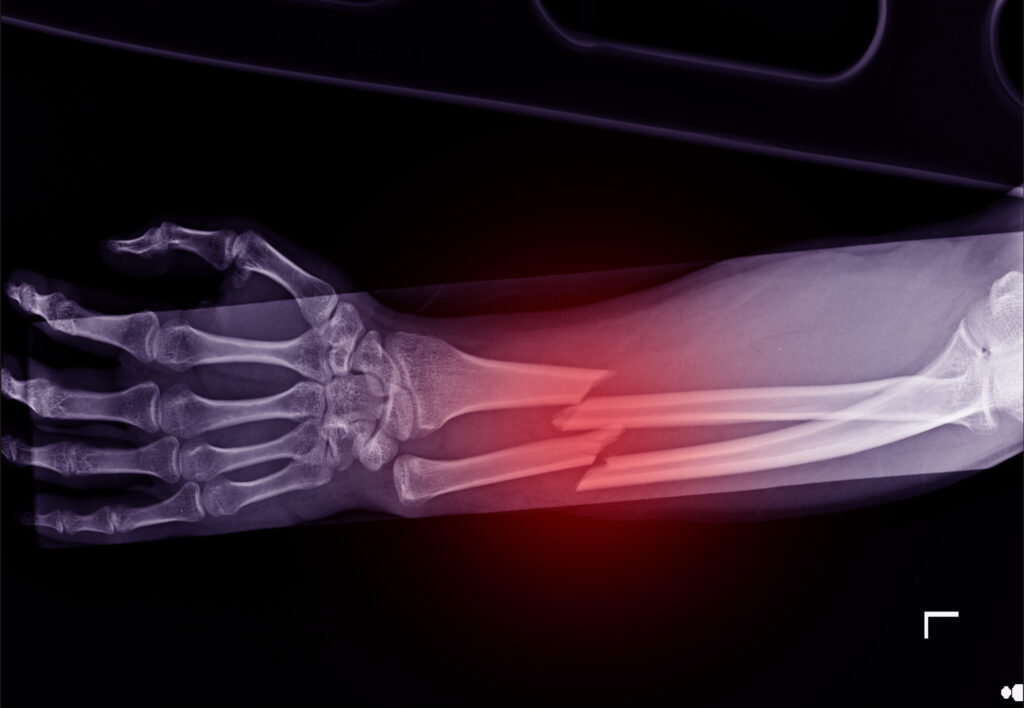Des Plaines Bone Fractures Lawyer