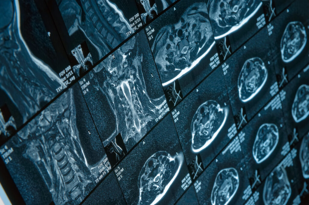 Tacoma Brain Injury Lawyer