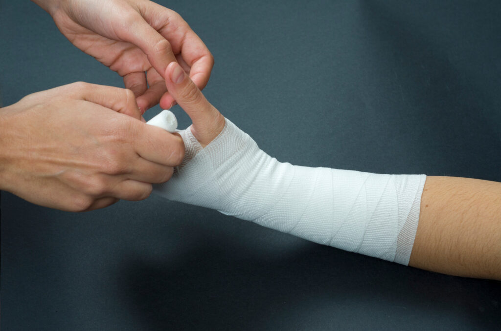 Tacoma Burn Injuries Lawyer