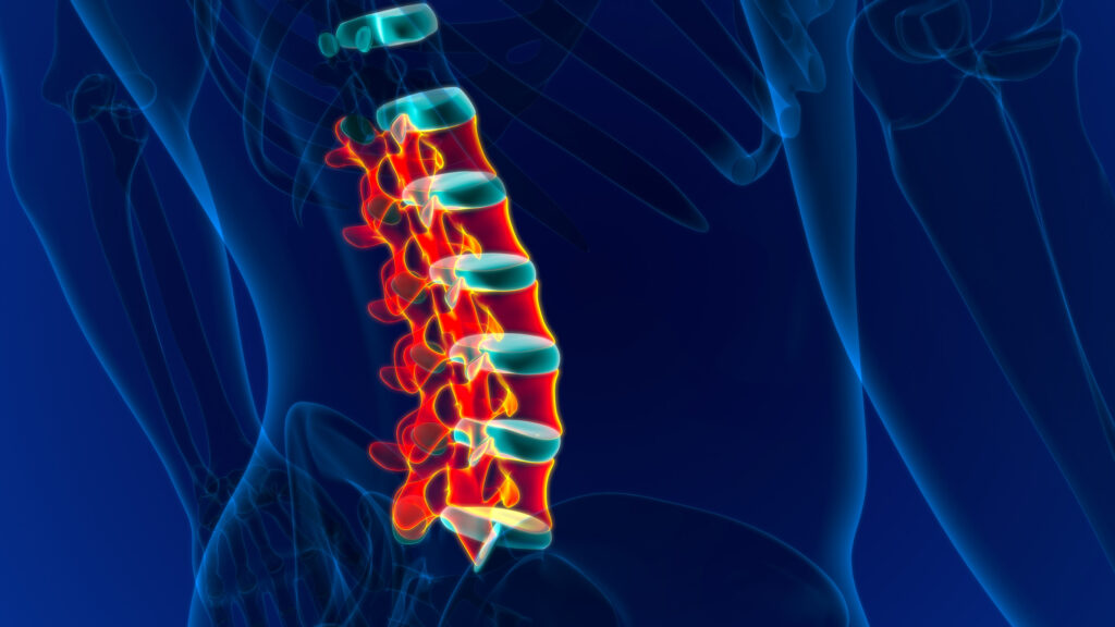 Tacoma Spinal Injury Lawyer