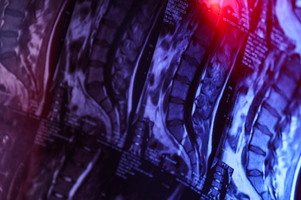 Laguna Niguel Spinal Injury Lawyer