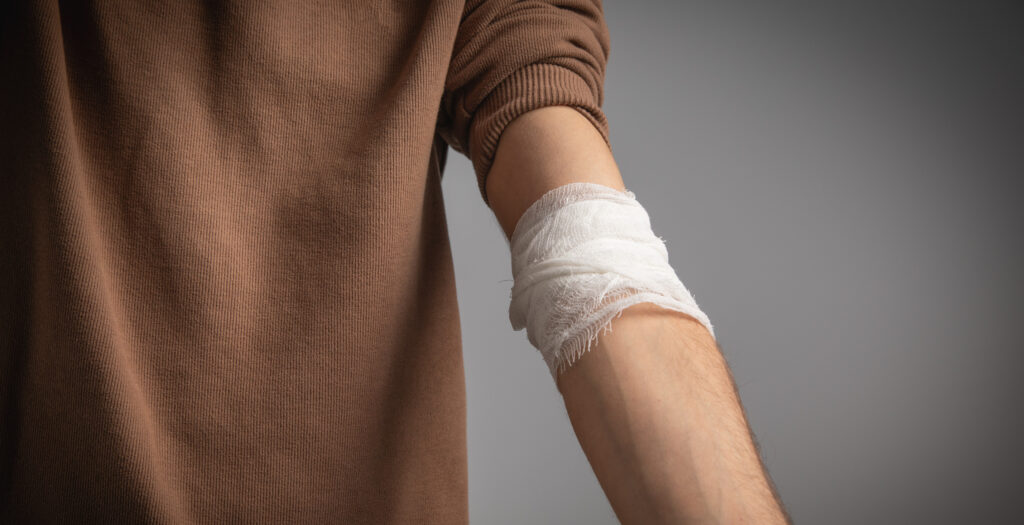 Mission Viejo Burn Injuries Lawyer