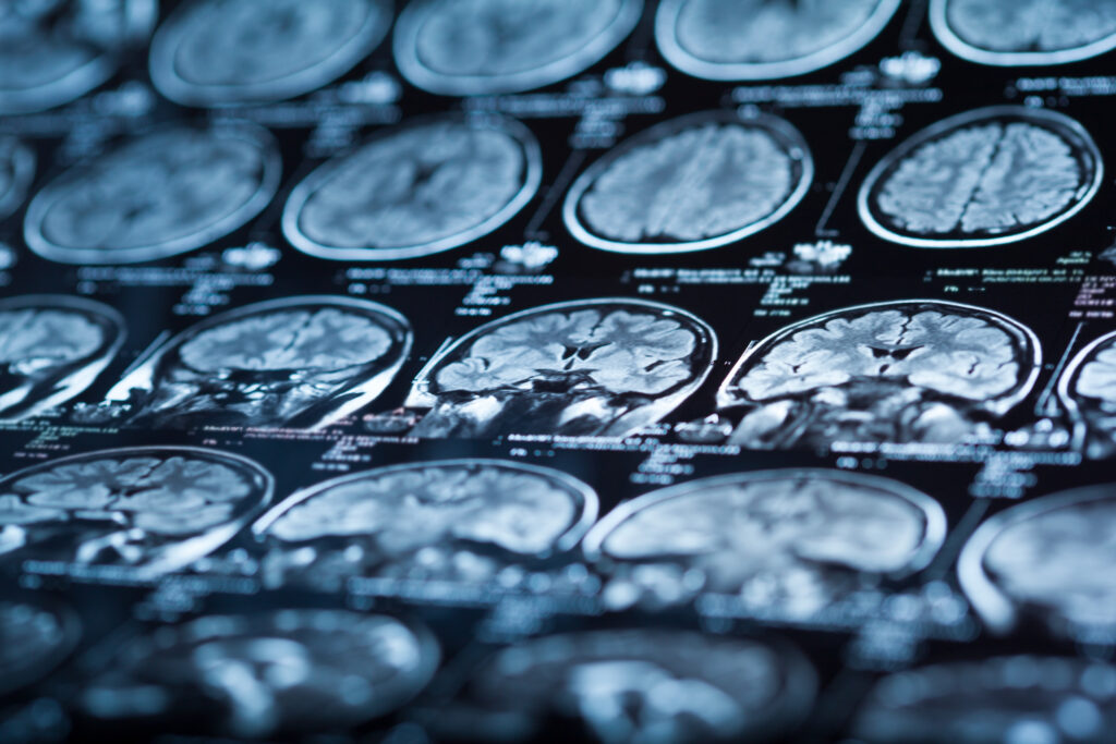 Santa Ana Brain Injury Lawyer