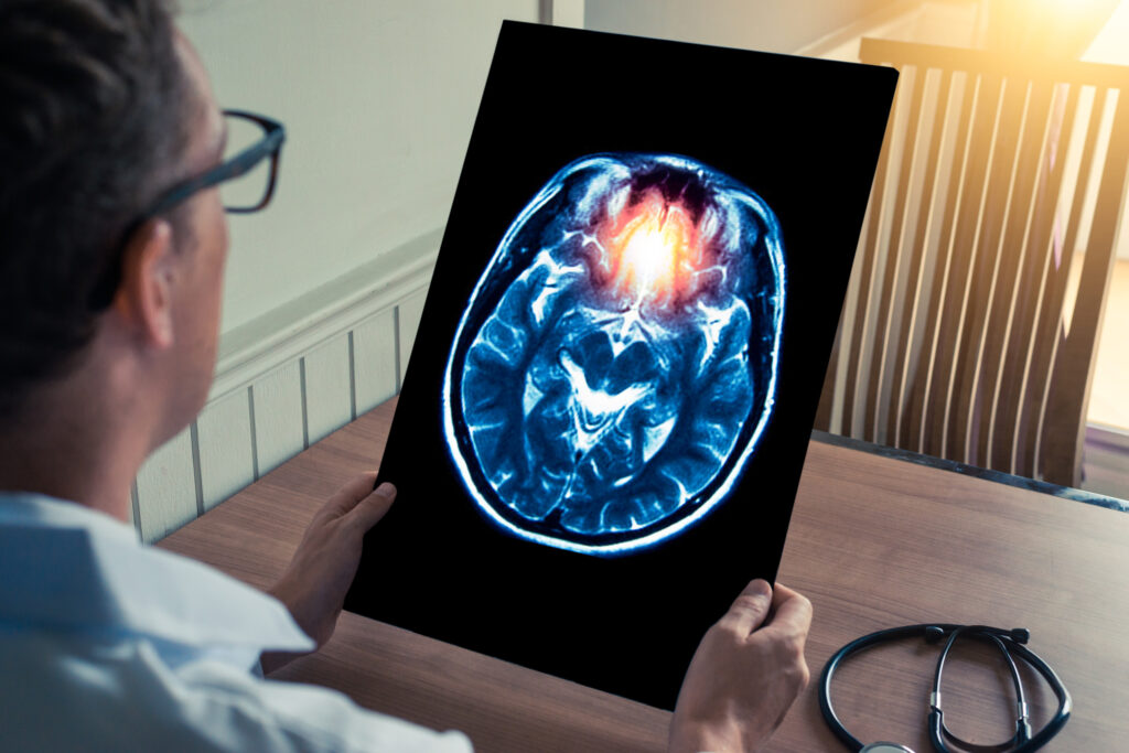 Anaheim Brain Injury Lawyer
