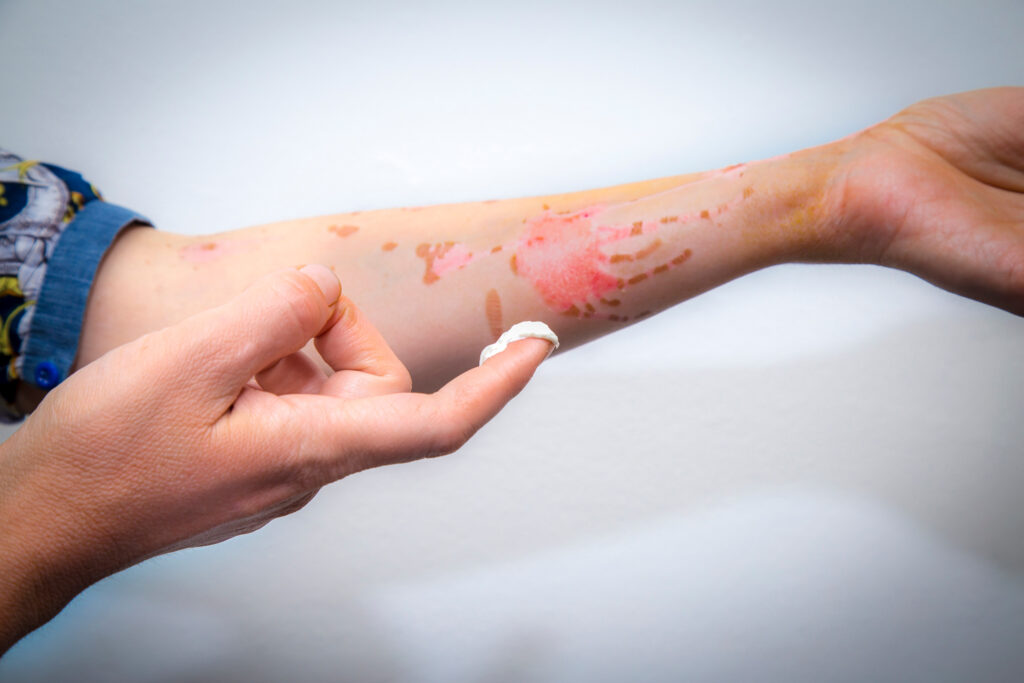 Costa Mesa Burn Injuries Lawyer