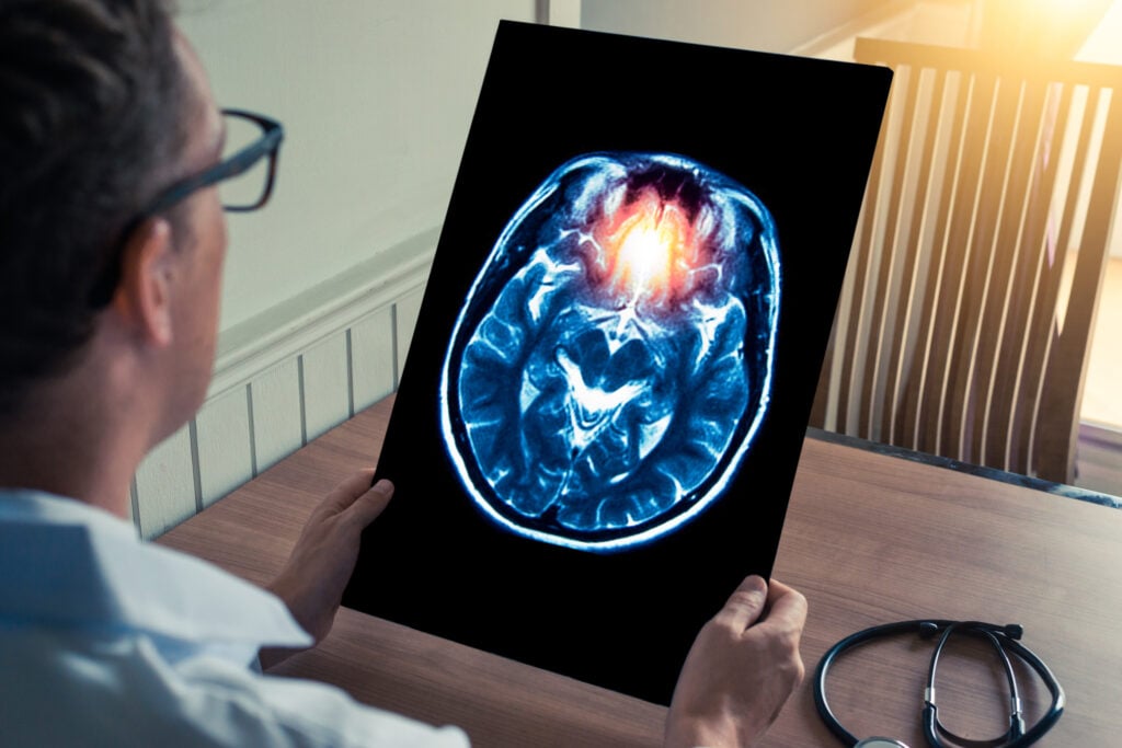 Fullerton Brain Injury Lawyer