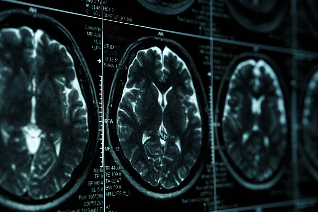Garden Grove Brain Injury Lawyer