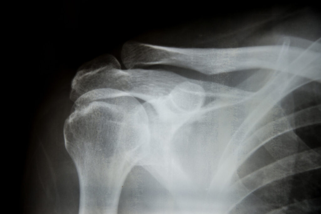 Huntington Beach Bone Fractures Lawyer