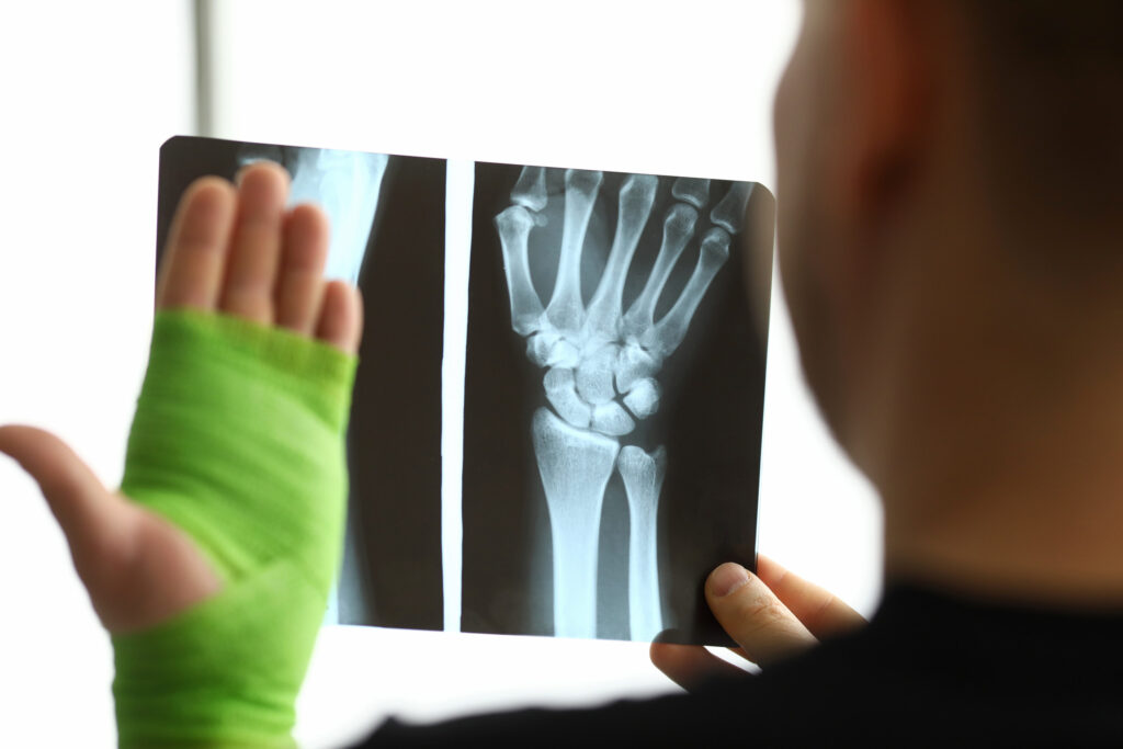 Irvine Bone Fractures Lawyer