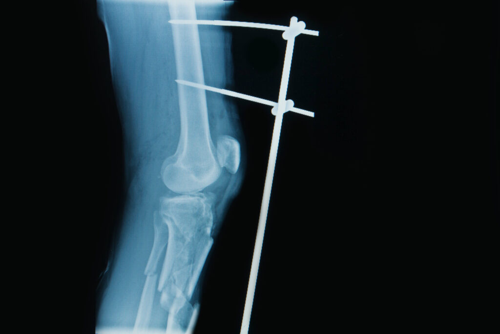 Lake Forest Bone Fracture Lawyer