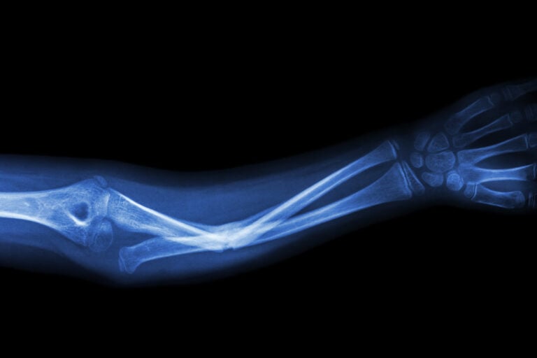 Bellevue Bone Fractures Lawyer