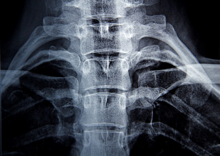 Fullerton Spinal Injury Lawyer