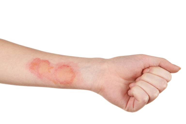 Laguna Beach Burn Injuries Lawyer