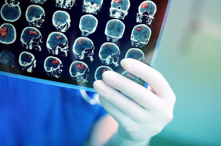 Peoria, Arizona, Brain Injury Lawyer