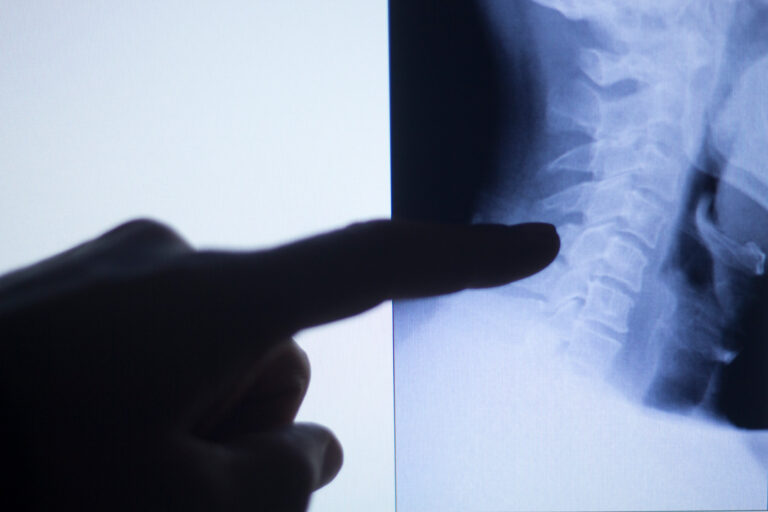 Goodyear Spinal Injury Lawyer