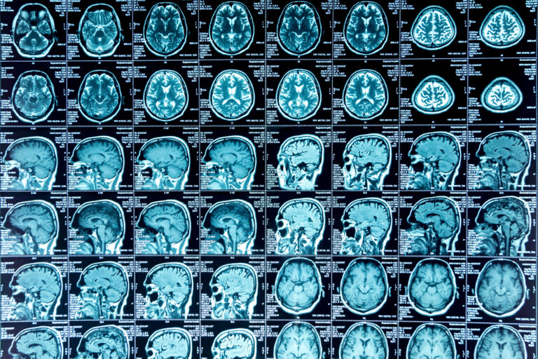 Huntington Beach Brain Injury Lawyer 