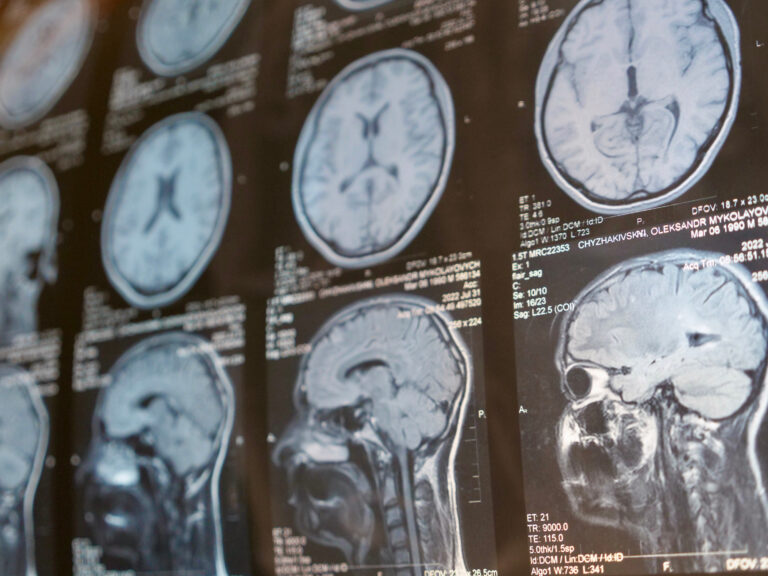 North Hollywood Brain Injury Lawyer