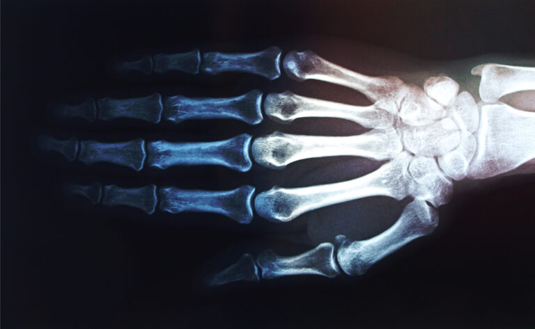 East Los Angeles Bone Fractures Lawyer