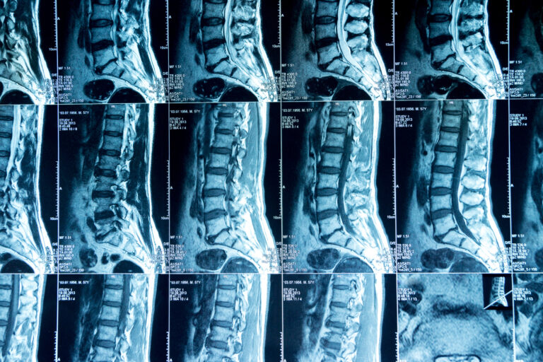 Victorville Spinal Injury Lawyer