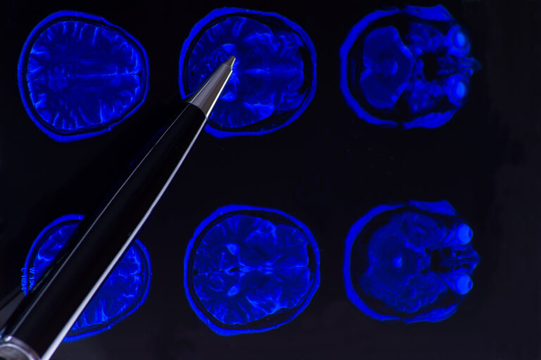 Rancho Cucamonga Brain Injury Lawyer